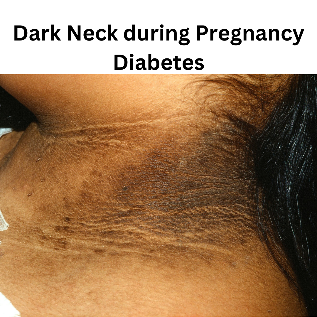 Read more about the article Myths About Dark Neck during Pregnancy and Role of  Diabetes in it